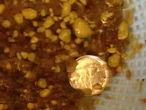 Gallstones, that came out after liver flush